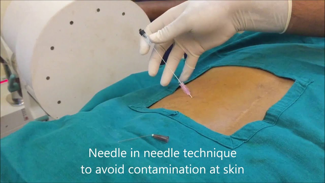 هزینه تزریق ژل برای دیسک کمر